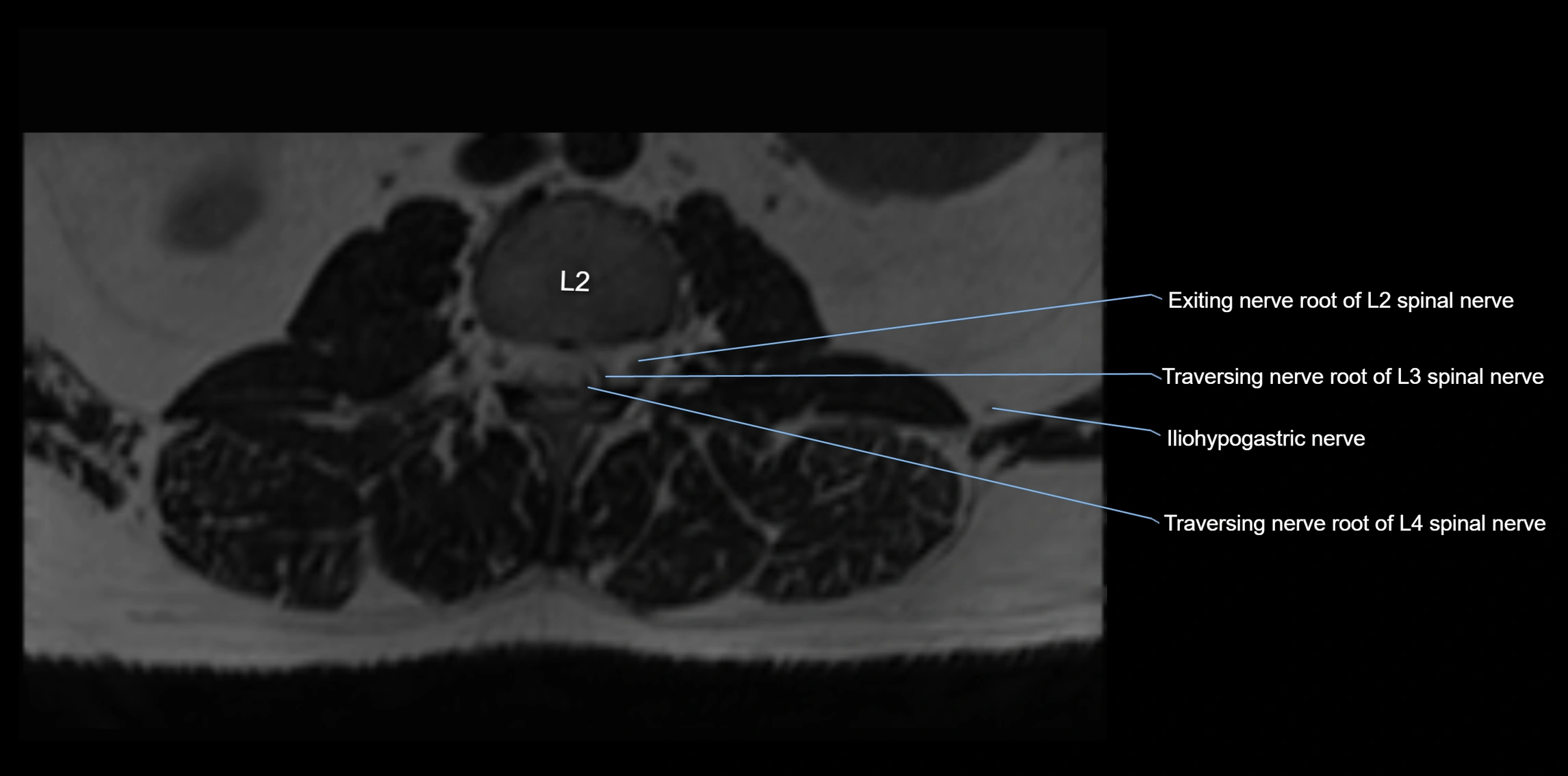 MR lumbosacral plexus axial cross sectional anatomy 3T  radiology  image-img-1008001-00006.webp